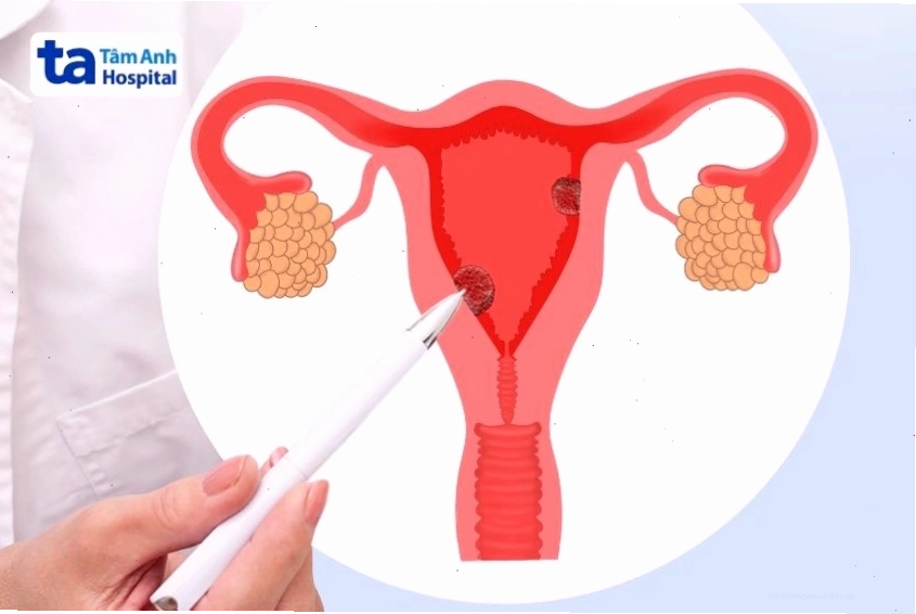 Polyp tử cung là một trong những nguyên nhân gây tiết dịch màu nâu ở âm đạo