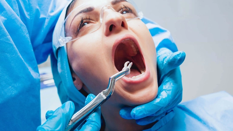 Quy trình nhổ răng khôn: Những điều cần biết và lưu ý