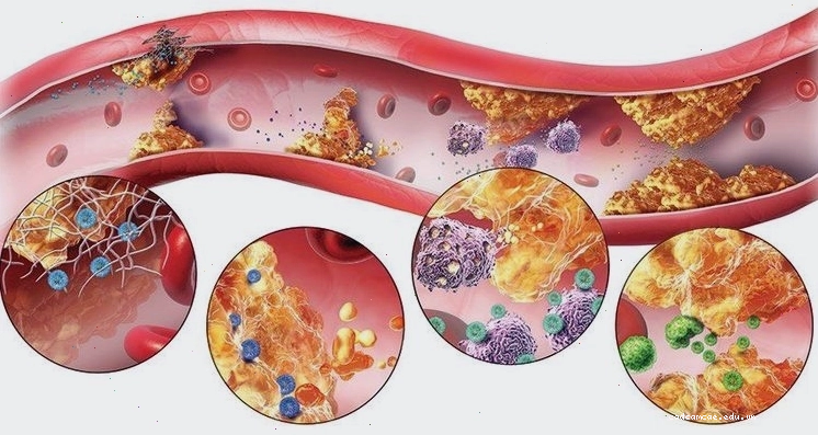 Rosuvastatin được sử dụng trong bệnh lý mỡ máu