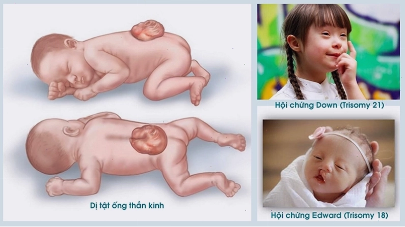 sàng lọc trước sinh không xâm lấn hỗ trợ phát hiện các dị tật bất thường ở cơ thể trẻ