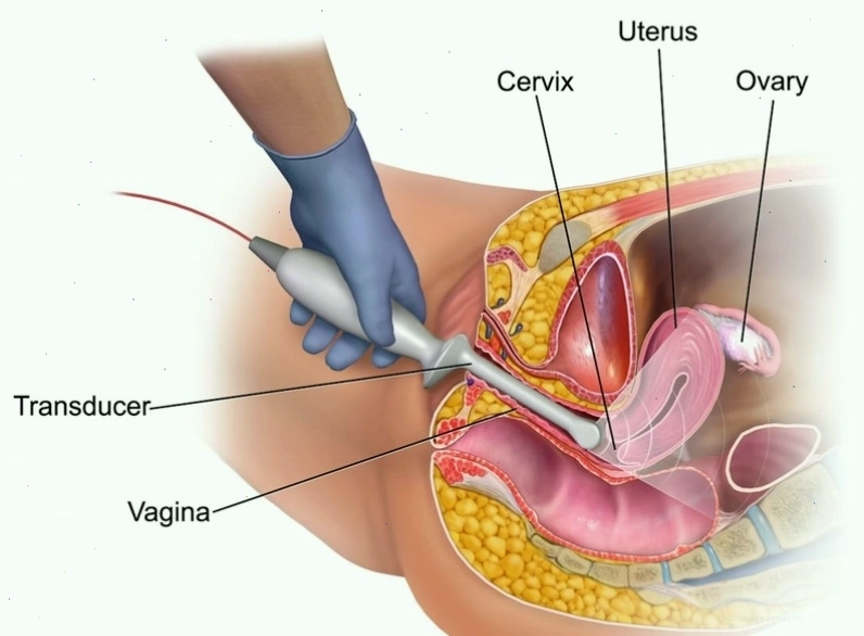Siêu âm đầu dò là kỹ thuật chẩn đoán hình ảnh