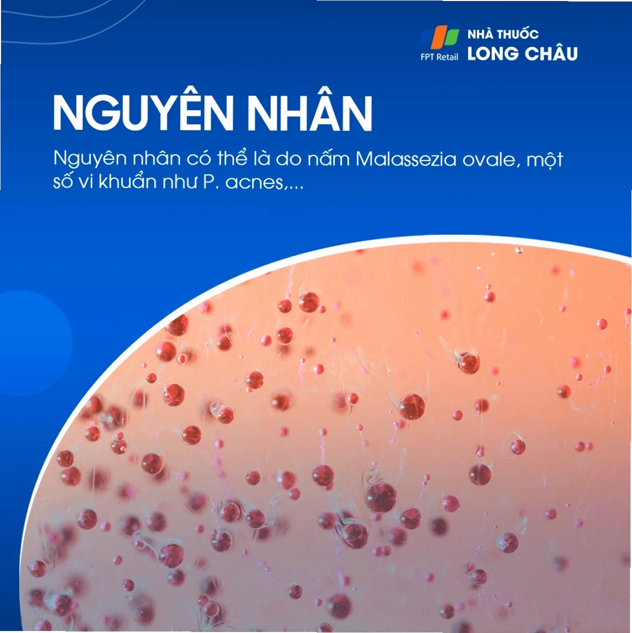 Sơ đồ minh họa nguyên nhân viêm da tiết bã do tăng tiết bã nhờn và vi khuẩn Malassezia