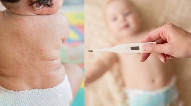 Sốt phát ban là gì? Nguyên nhân, biểu hiện và cách điều trị hiệu quả