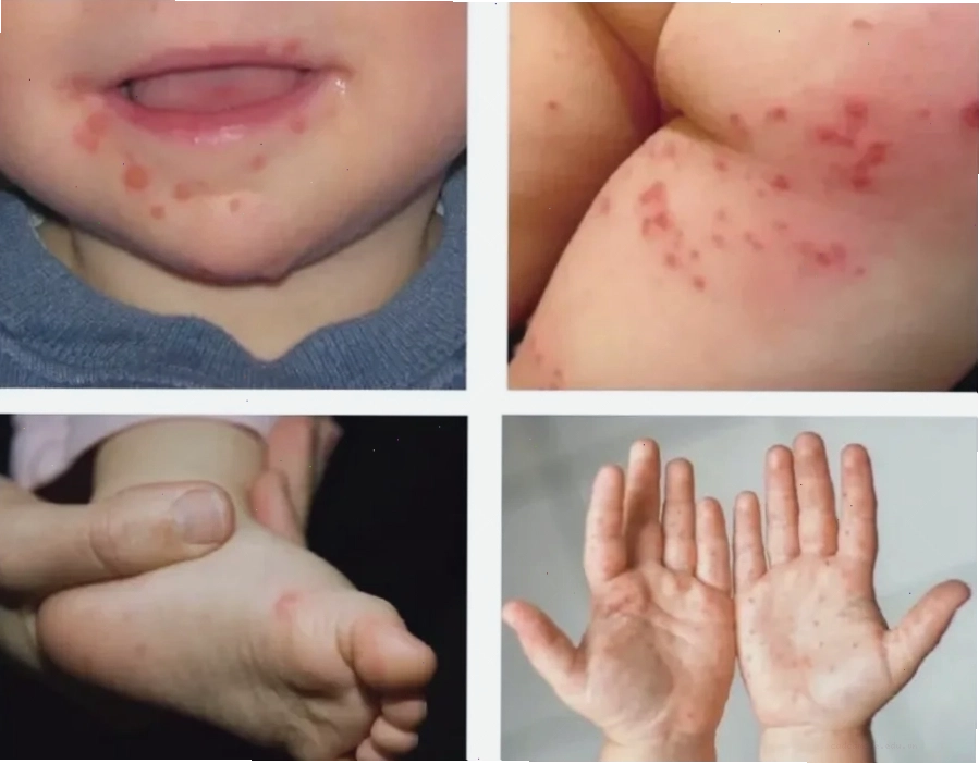 Trẻ em dưới 5 tuổi là độ tuổi phổ biến mắc tay chân miệng