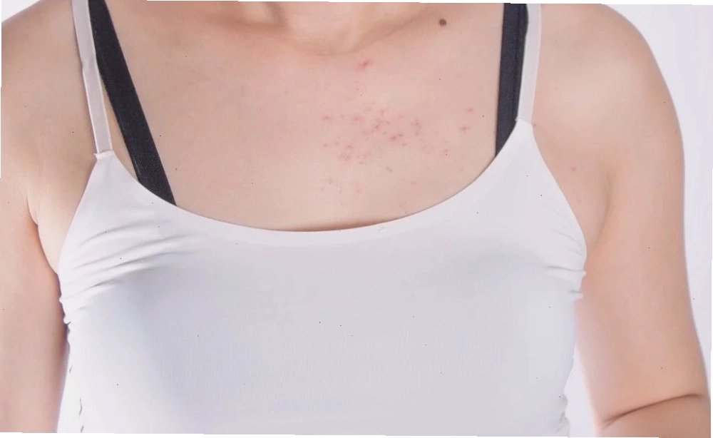 Triệu chứng của viêm nang lông thể hiện qua các nốt mụn đỏ và mụn mủ