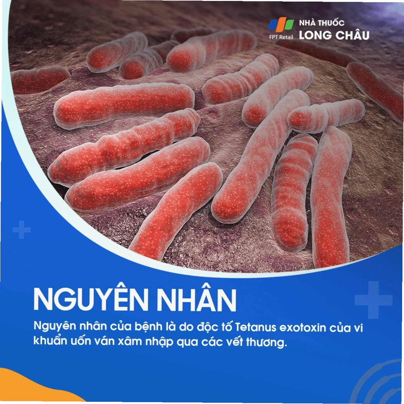 Vết thương bị nhiễm trùng vi khuẩn Clostridium tetani, nguyên nhân gây bệnh uốn ván