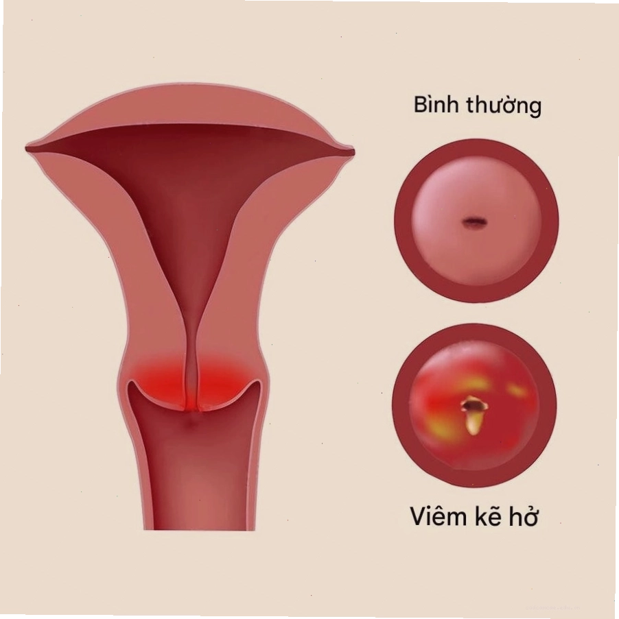 Viêm cổ tử cung mạn tính là một trong những nguyên nhân chính hình thành nang Naboth
