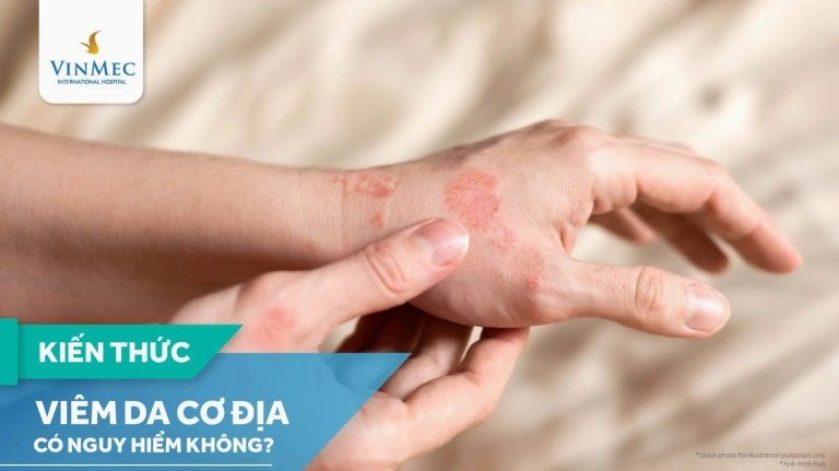 Viêm Da Cơ Địa: Những Điều Cần Biết Và Cách Xử Lý Hiệu Quả