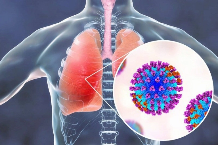 Viêm Phổi Các Loại Nguyên Nhân Triệu Chứng Chẩn Đoán Điều Trị Và Phòng Ngừa