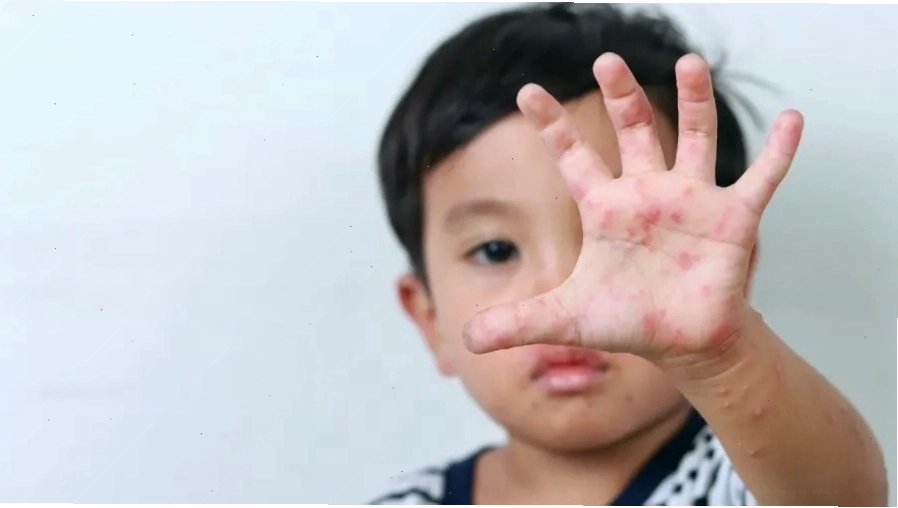 Virus tay chân miệng có thể lây lan nhanh trong cộng đồng