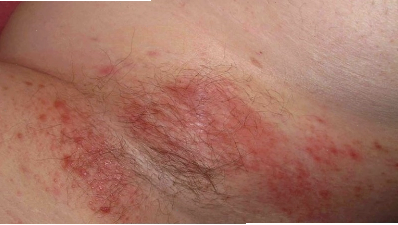 Vùng nách ẩm ướt là nơi lý tưởng cho nấm Candida phát triển
